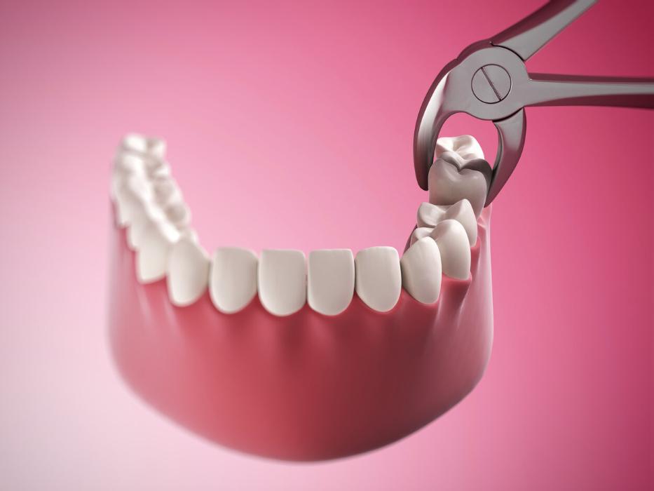 tooth extraction 