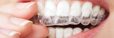 close up of patient putting invisalign on their teeth from.a sandpoint dental office