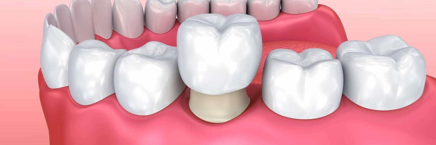 dental crown from coeur d'alene dental office