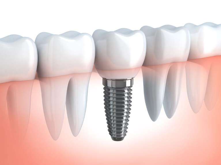 image of a dental implant in ponderay