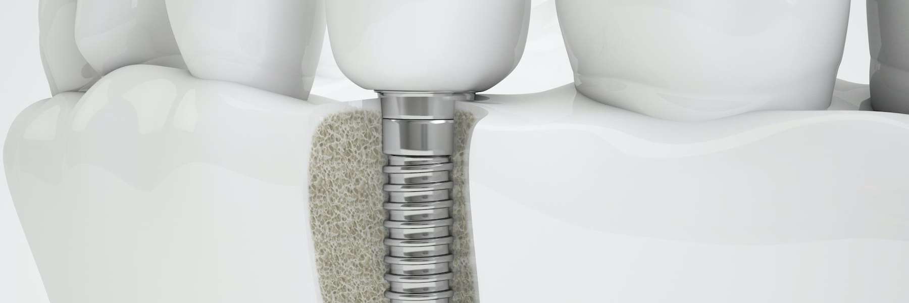 dental implant 