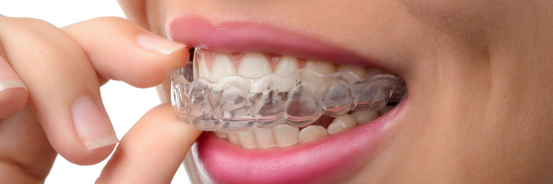 girl wearing clear braces in ponderay