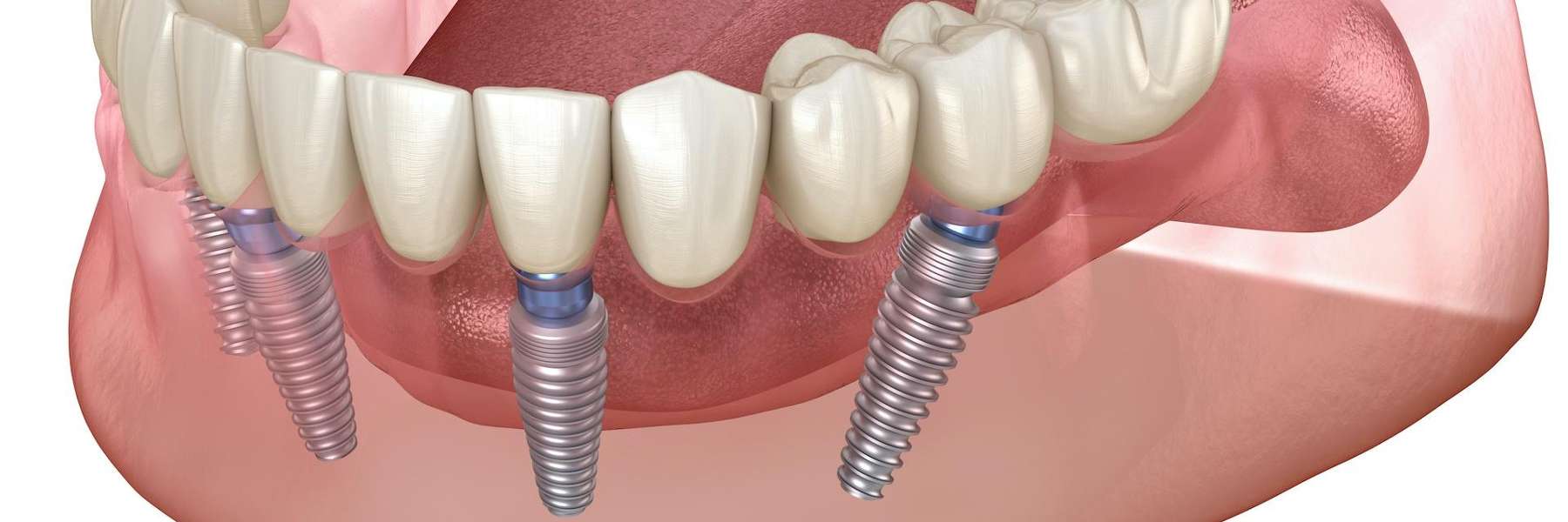 illustration of dental implants