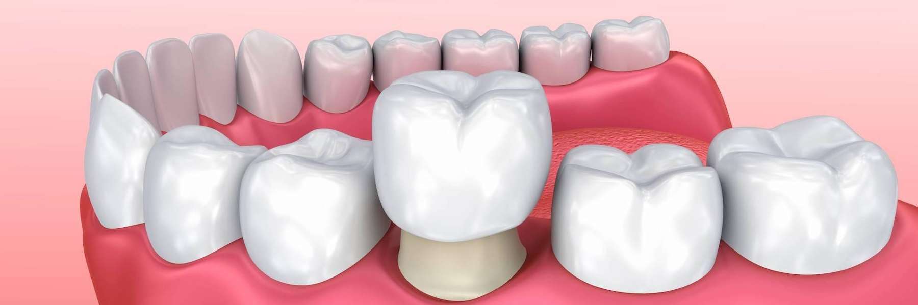 image of a tooth crown in coeur d'alene