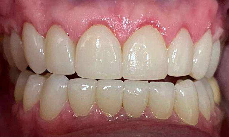 After treatment - Case 1