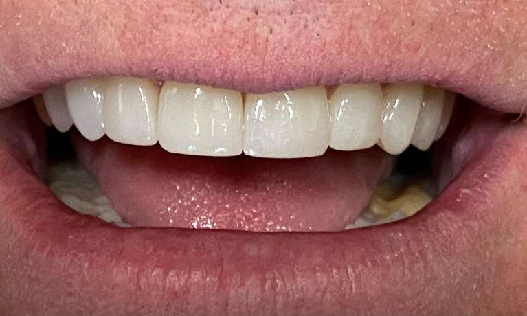 After treatment - Case 2