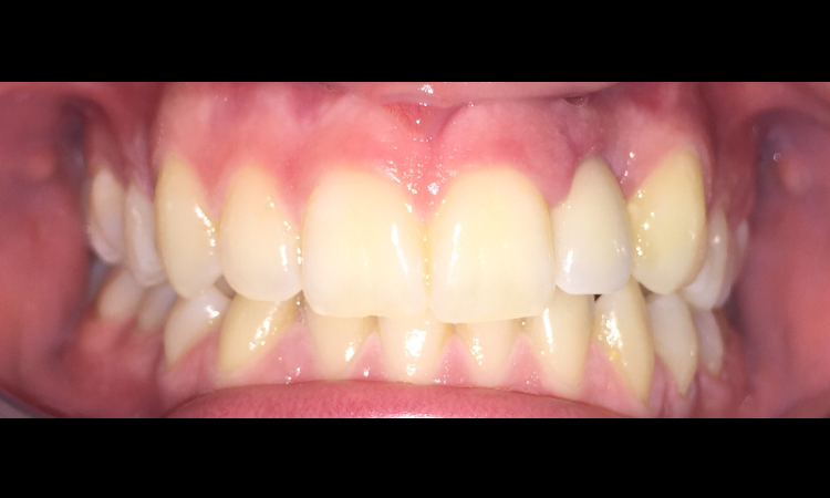 After treatment - Case 4
