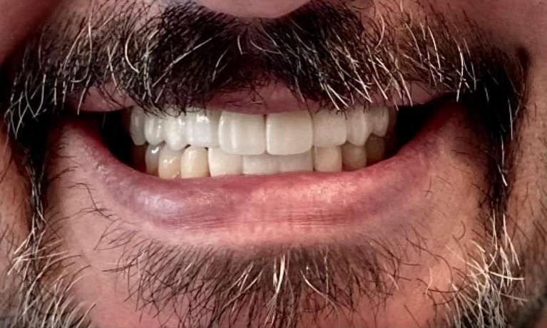 After treatment - Case 6