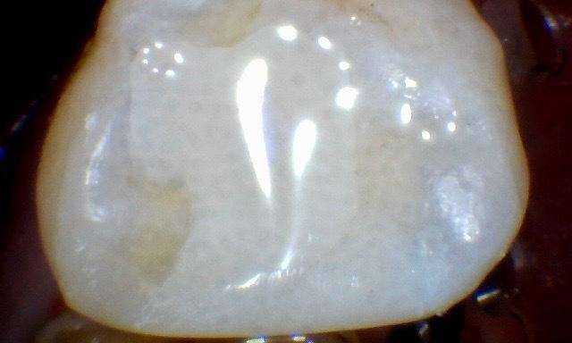 After treatment - Case 5