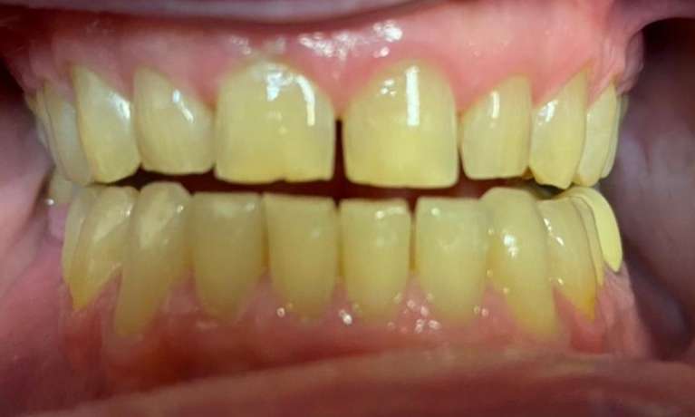 Before treatment - Case 1