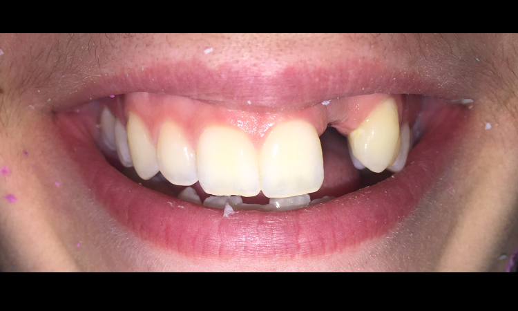 Before treatment - Case 4