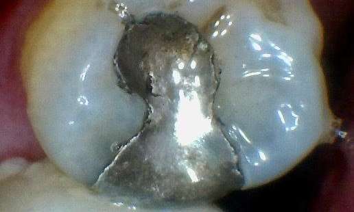Before treatment - Case 5