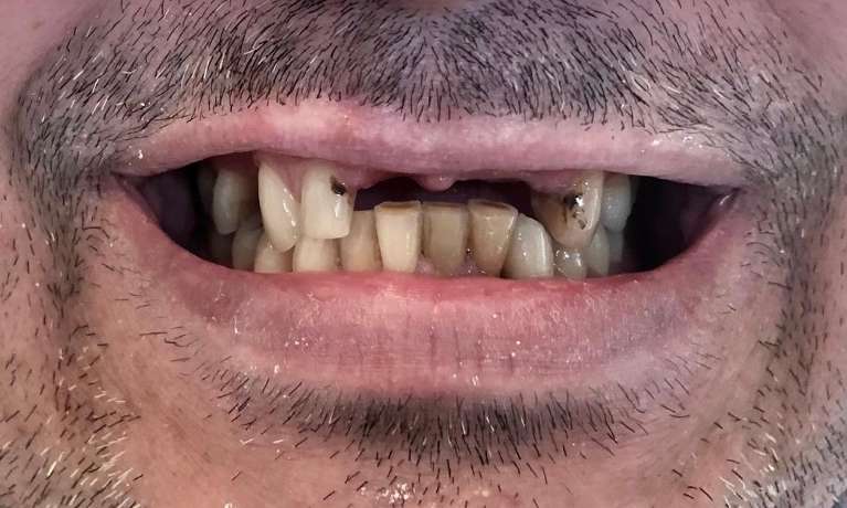 Before treatment - Case 6